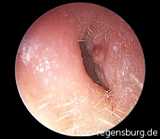 Bösartige Gehörgangsentzündung links