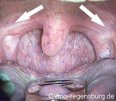 Narbenbildung nach der Tonsillektomie